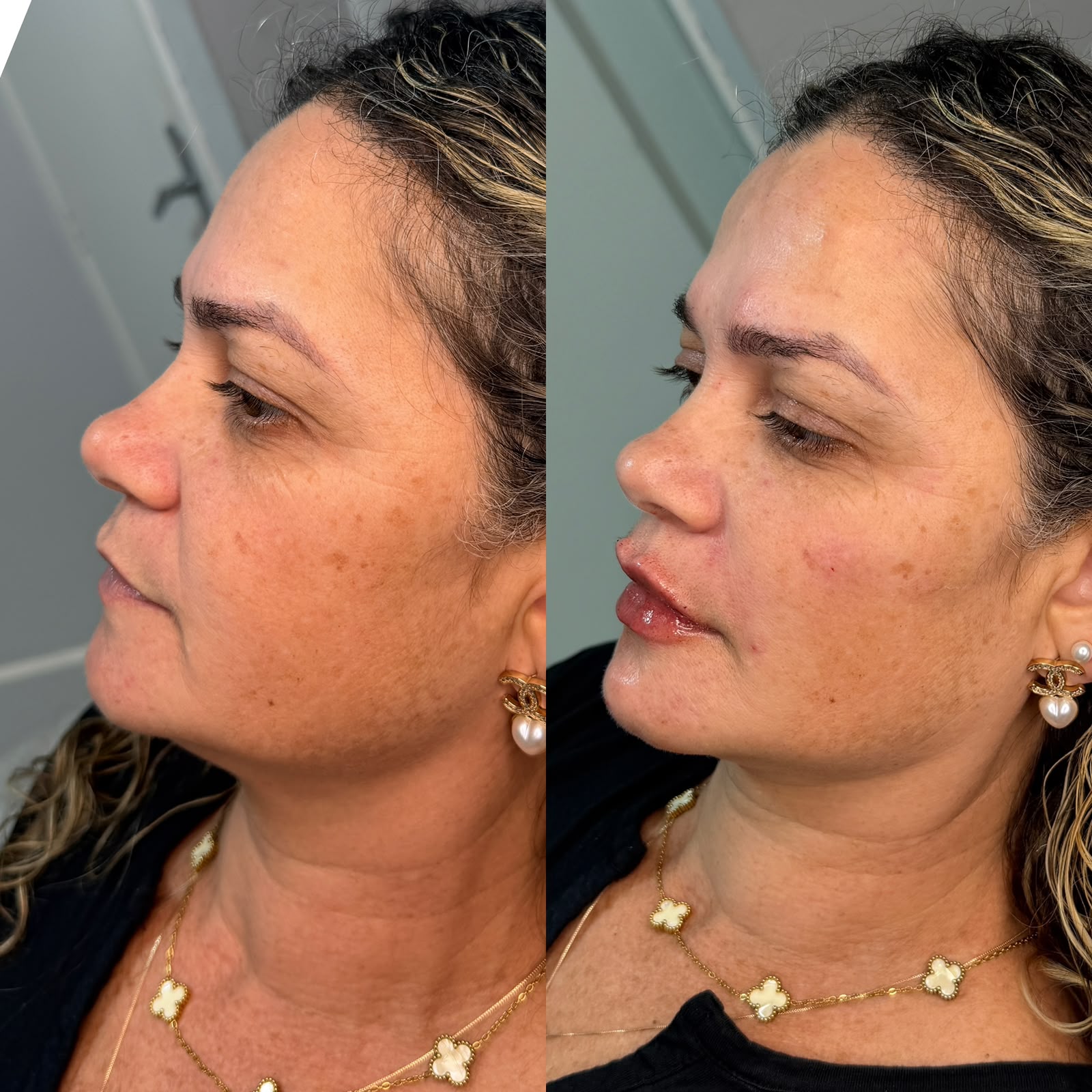 Resultado: Perfiloplastia — antes e depois