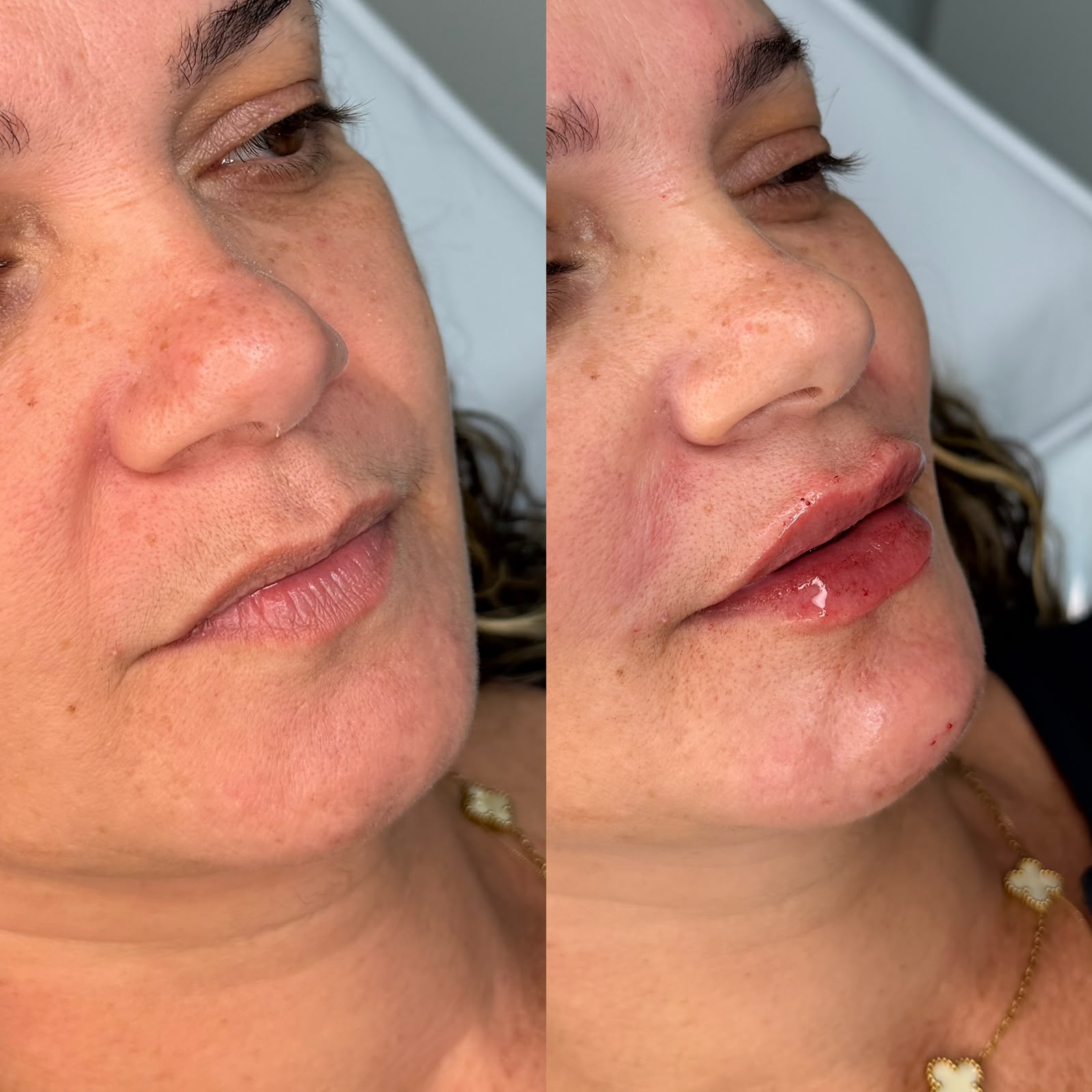 Resultado: Harmonização Facial — antes e depois