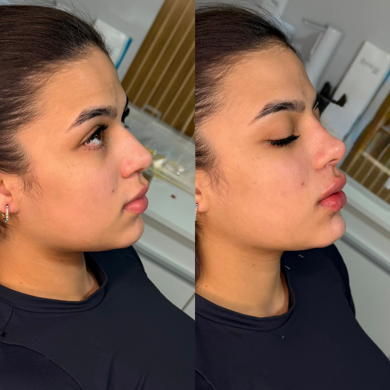 Resultado: Perfiloplastia — antes e depois