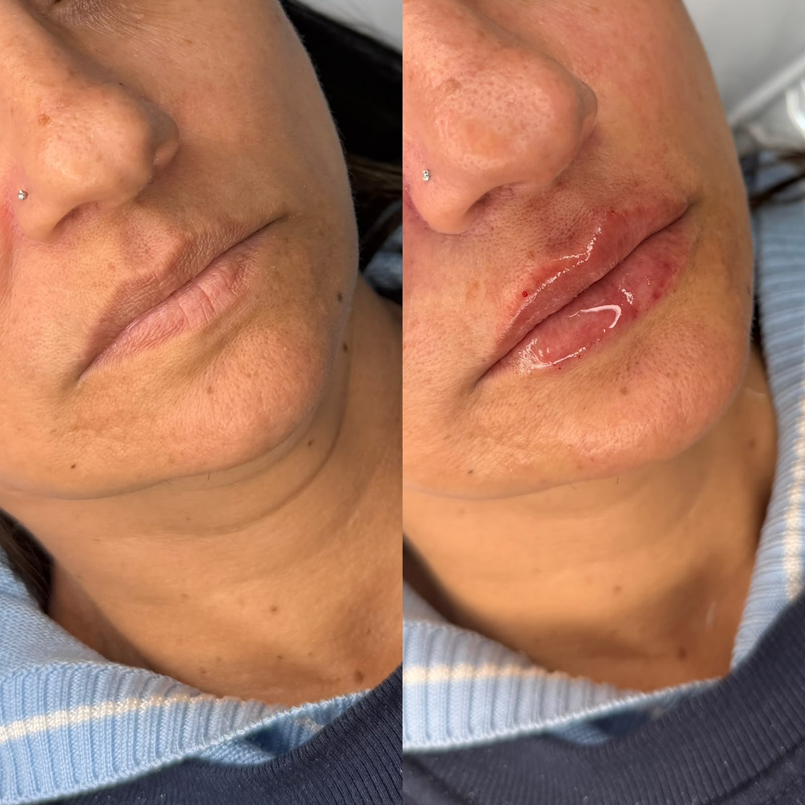 Resultado: Preenchimento Labial — antes e depois