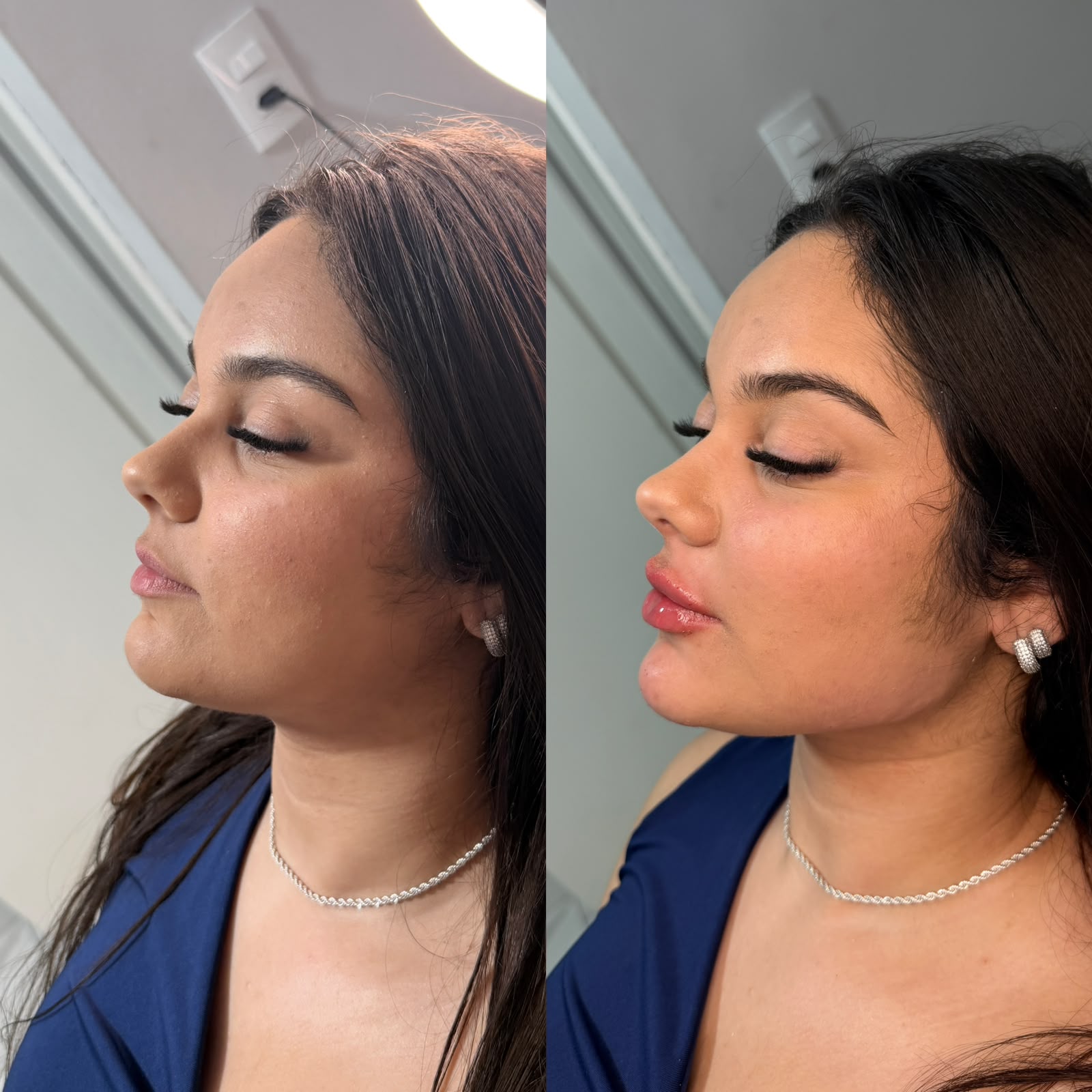 Resultado: Harmonização Facial — antes e depois