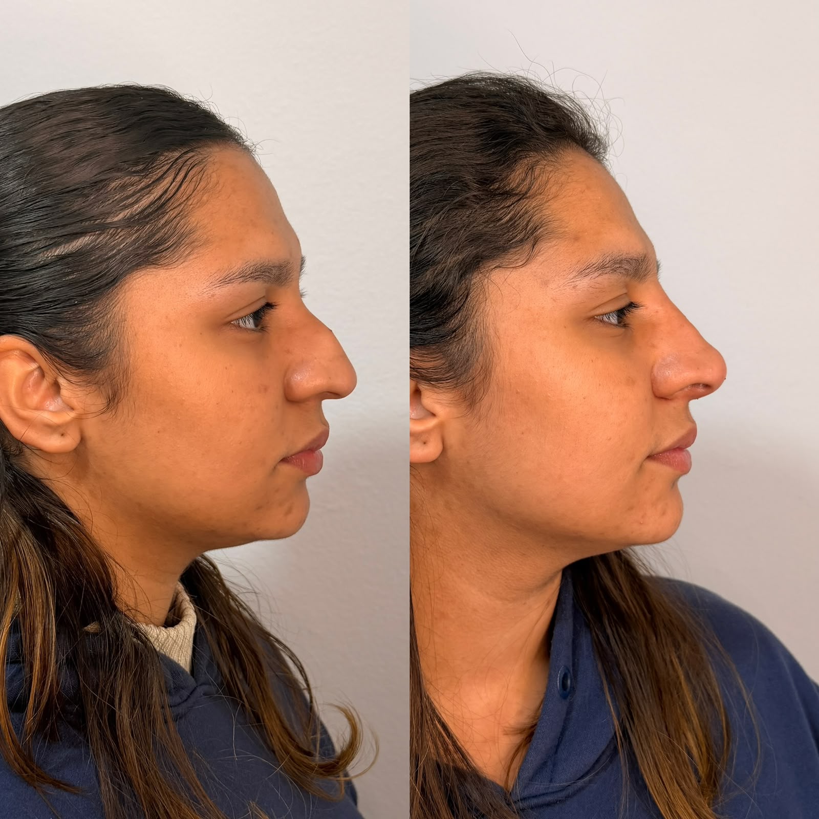 Resultado: Rinomodelação — antes e depois
