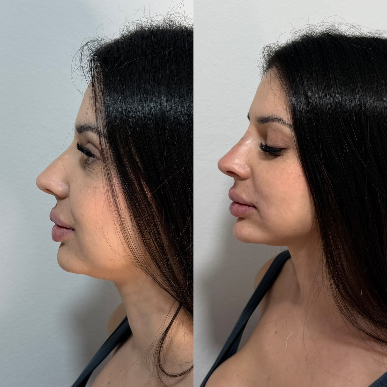 Resultado: Harmonização Facial — antes e depois