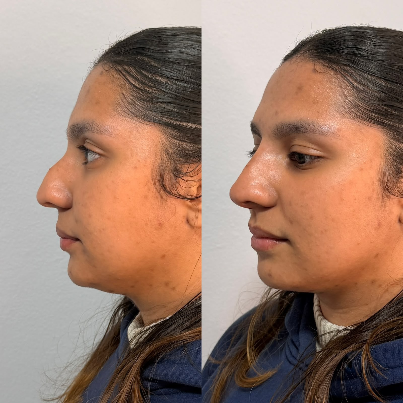 Resultado: Rinomodelação — antes e depois